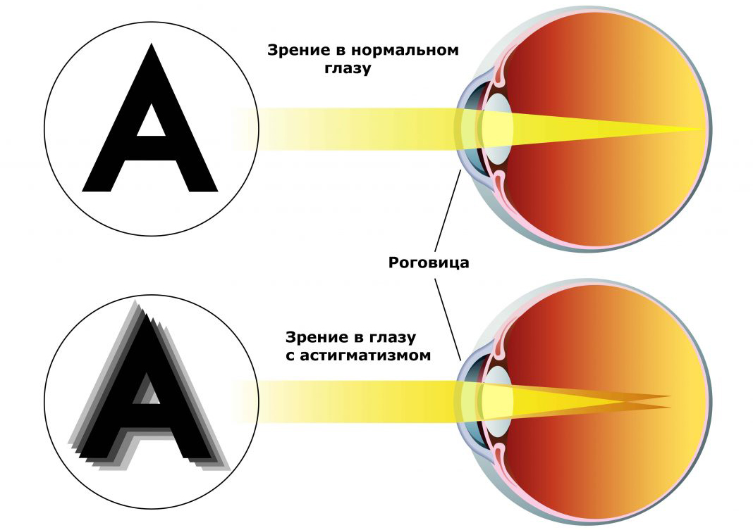 Что такое астигматизм?